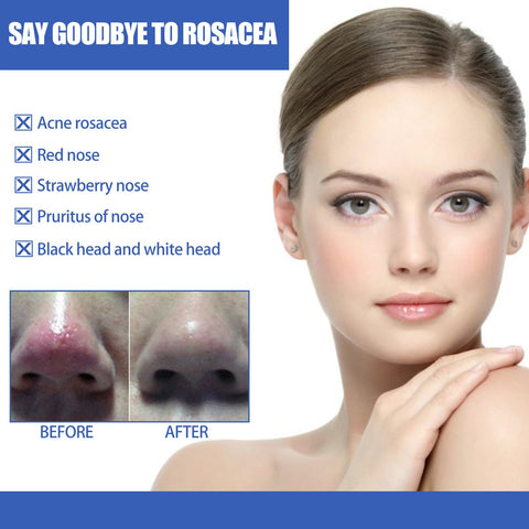 Remover Serum Treatment Liquid Mark Anti Nose Mites-BH00232-Veeddydropshipping