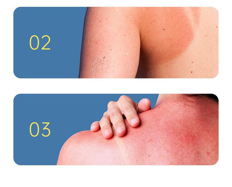 Sun Treatment Oil Sunburn Care-BH00331-Veeddydropshipping
