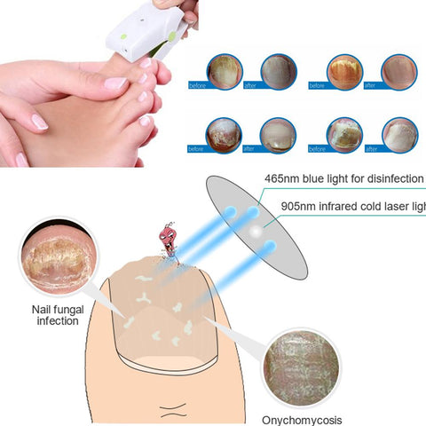 painless nail fungus therapeutic instrument Laser foot care-BH00883-Veeddydropshipping