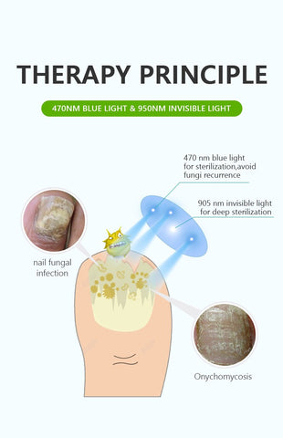 painless nail fungus therapeutic instrument Laser foot care-BH00883-Veeddydropshipping