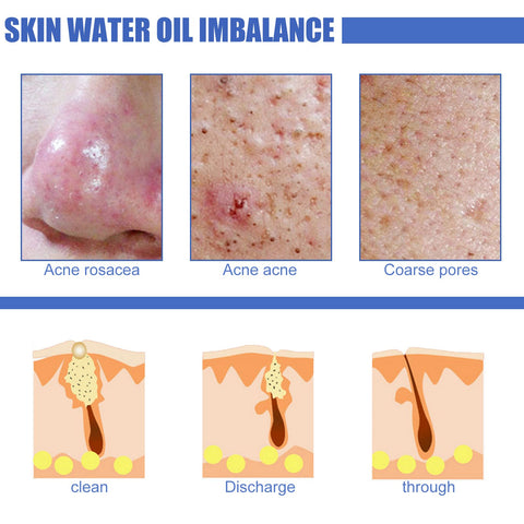 Remover Serum Treatment Liquid Mark Anti Nose Mites-BH00232-Veeddydropshipping